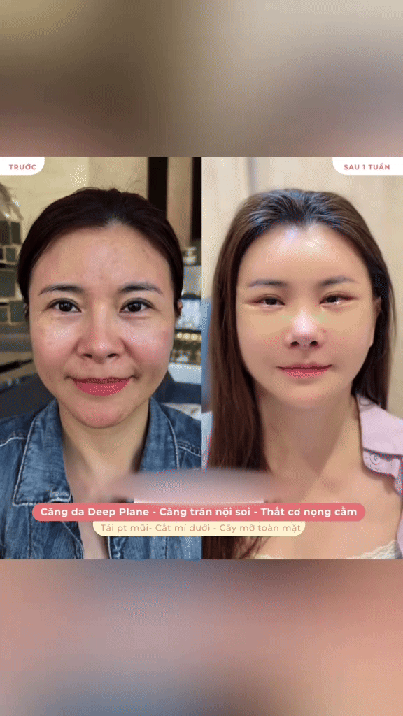Diễn viên Kim Oanh với diện mạo mới sau phẫu thuật thẩm mỹ
