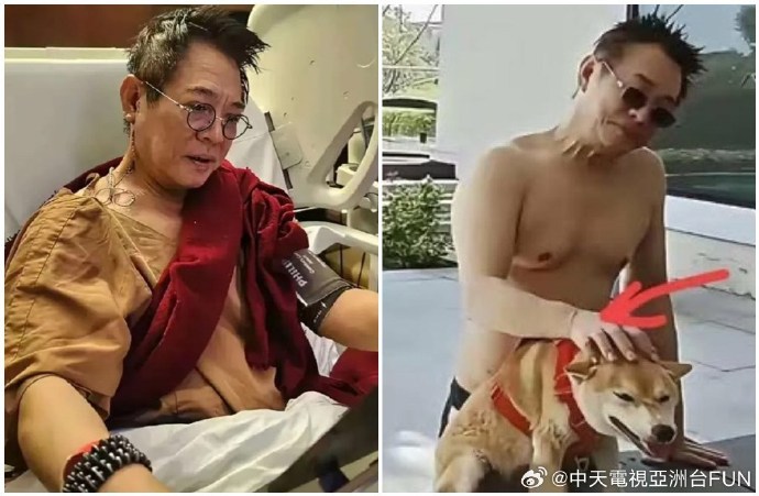 Phẫu thuật cắt u cổ của Lý Liên Kiệt